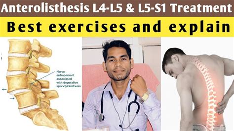 Anterolisthesis L5 S1 Treatment Anterolisthesis Grade 1 Treatment Exercises L4 L5 Lumbar Spine