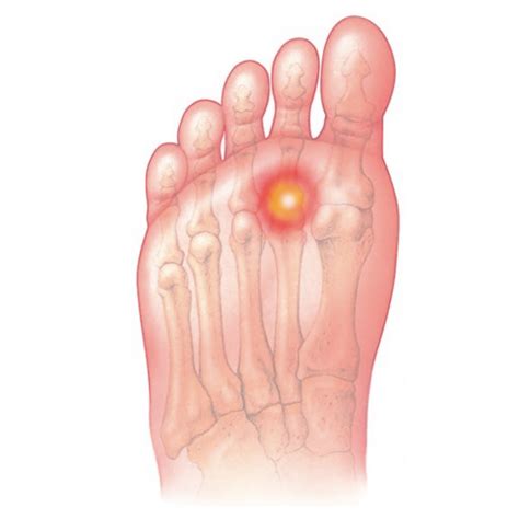Pain In The Ball Of Your Foot