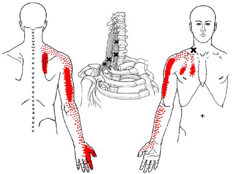 Massage And Facts On Muscle Knots ⋆ Santa Barbara Deep Tissue Riktr Pro
