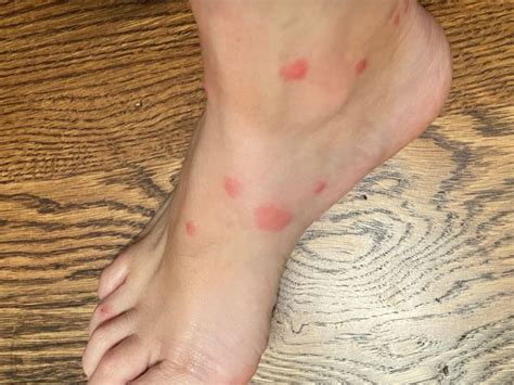 Home Remedies For Fire Ant Bites That Really Work Convos With Karen