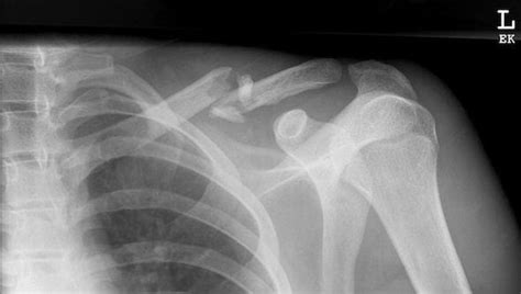Clavicle Fractures • Litfl • Trauma Library
