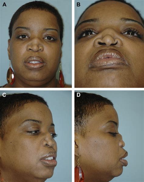 Classification And Treatment Of The Saddle Nose Deformity Ento Key