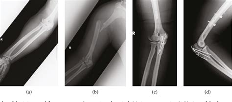 Figure 1 From Surgical Treatment For Malunion Of The Lateral Humeral