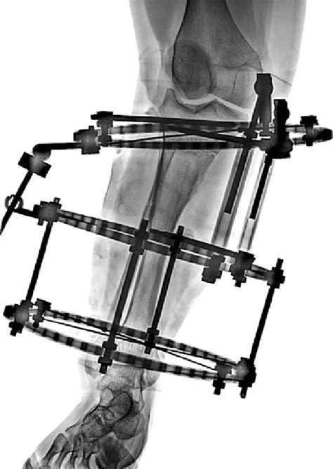 Postoperative Ap Radiograph Of The Right Tibia After High Proximal