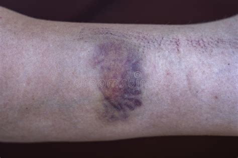 Purple Bruise On The Skin On A Woman Hand Stock Photo Image Of Female