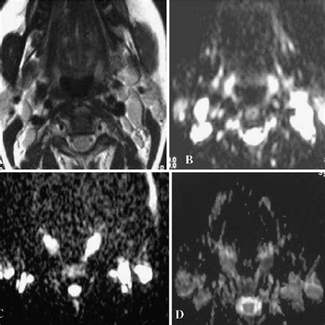 Pdf Role Of Diffusion Weighted Mr Imaging In Cervical Lymphadenopathy