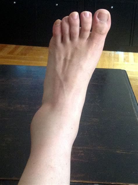 Swelling Ankles Feet Injury