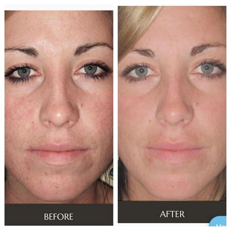 Clear And Brilliant Before And After Acne Scars