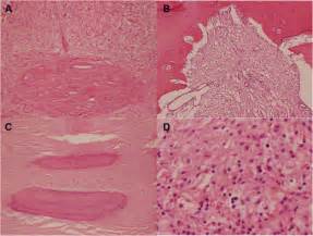 Histopathology A Replacement Of Bone By Fibrous Tissue With Variable