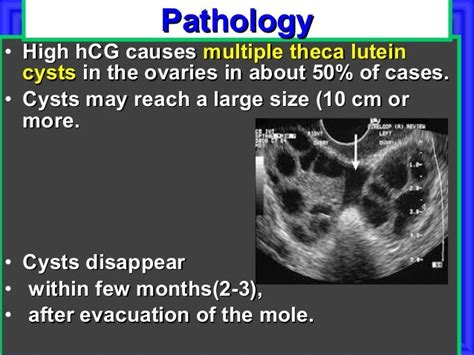 Vesicular Mole For Undergraduate