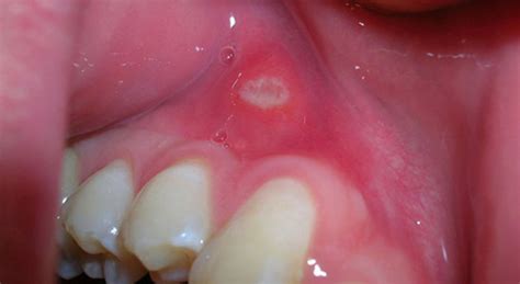 White Spots On Gums Above Teeth