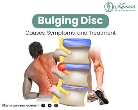 bulging disc causes symptoms and treatment