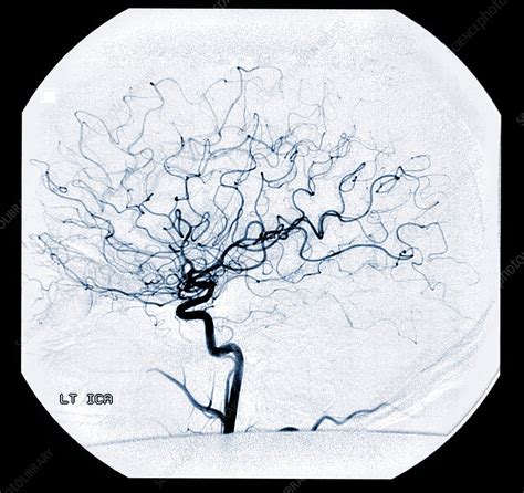 Left Internal Carotid Artery Angiogram Stock Image C0034790