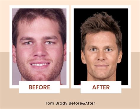 Unveiling The Truth Behind Tom Bradys Plastic Surgery Procedures