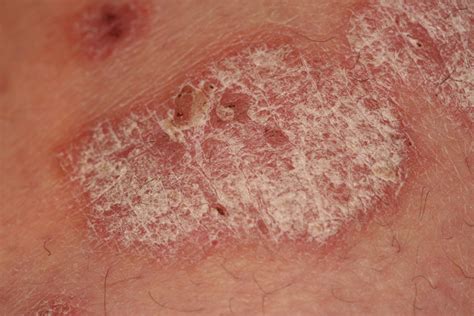 Psoriasis Skin Lesions