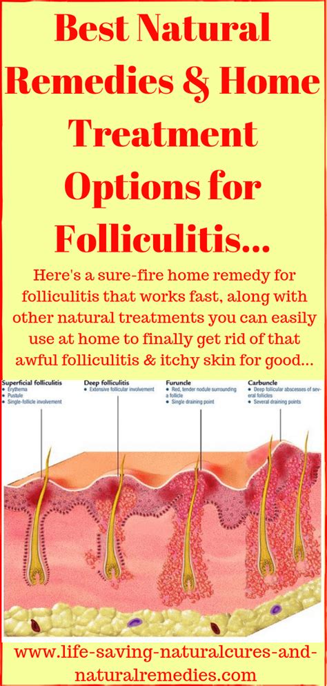 15 Natural Home Remedies For Folliculitis Cure Signs Symptoms Treatment