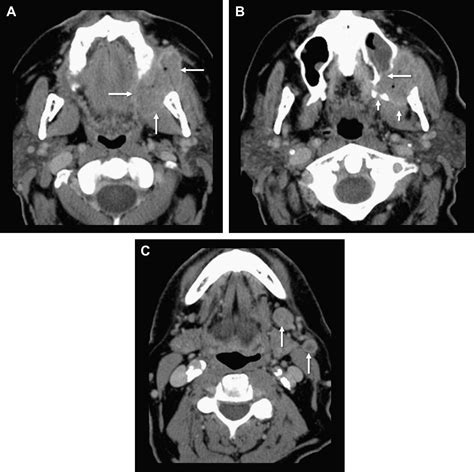 Pitfalls In The Staging Of Cancer Of Oral Cavity Cancer Neuroimaging