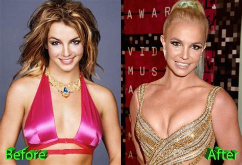 Britney Spears Plastic Surgery Few More Times