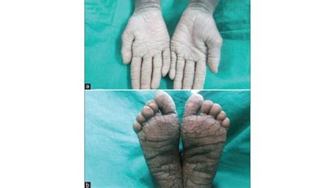 Ichthyosis Types Symptoms Causes And More