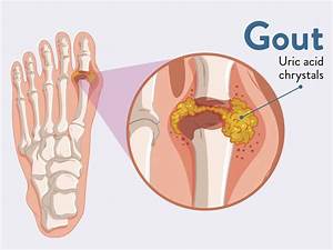About Gout: Managing and Preventing Attacks - Boulder Medical Center Gout  