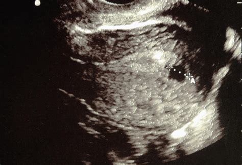 6 Week Ultrasound Heartbeat