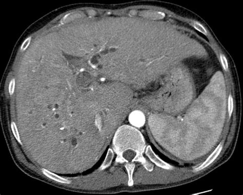 Often these patients are infection of the respiratory tract and urinary system. Liver Atlas: Case 35: Cirrhosis: Secondary to biliary ...