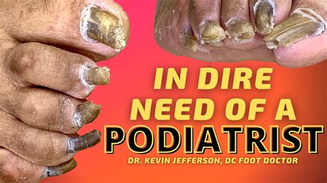 In Dire Need Of A Podiatrist Trimming Thick Fungal Toenails Youtube