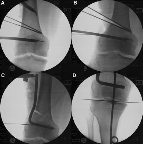 Intraoperative Fluoroscopy Of A Closed Wedge Distal Femur Osteotomy