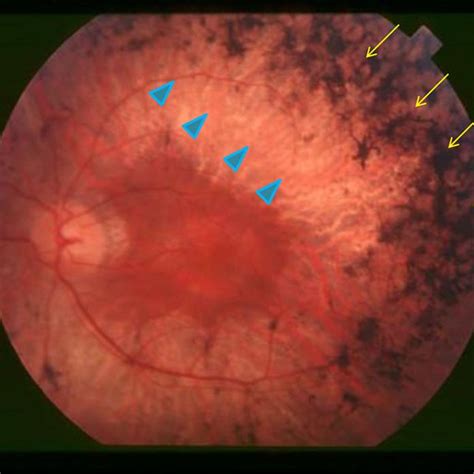 Fundoscopic Examination Of The Retina Shows The Typical Retinal