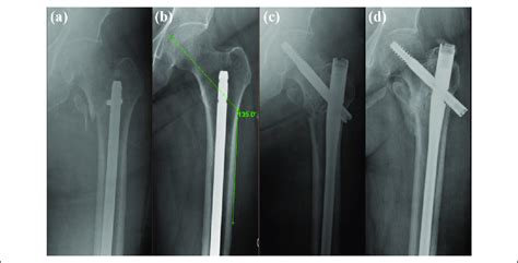 Case 4 Female 67 Peri Implant Inter Trochanteric Fracture A