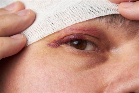 200 Hematoma Face Stock Photos Pictures And Royalty Free Images Istock