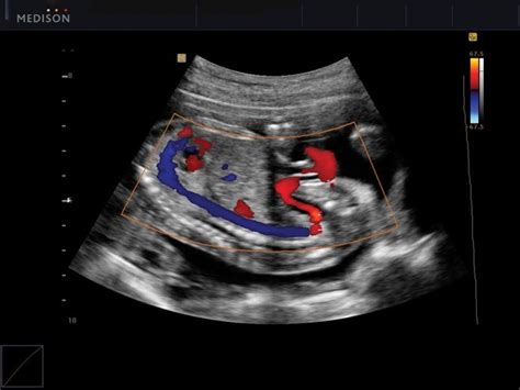 Ultrasound Images • Fetal Blood Circulation Color Doppler Echogramm №520