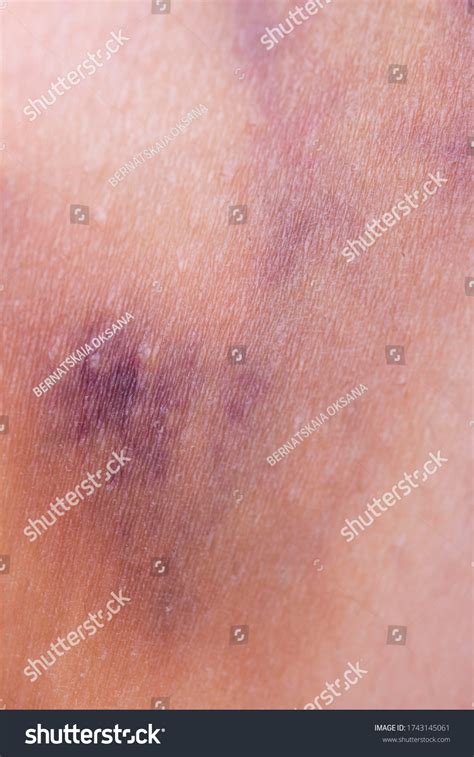 Hematoma On Skin Legs Stock Photo Edit Now 1743145061
