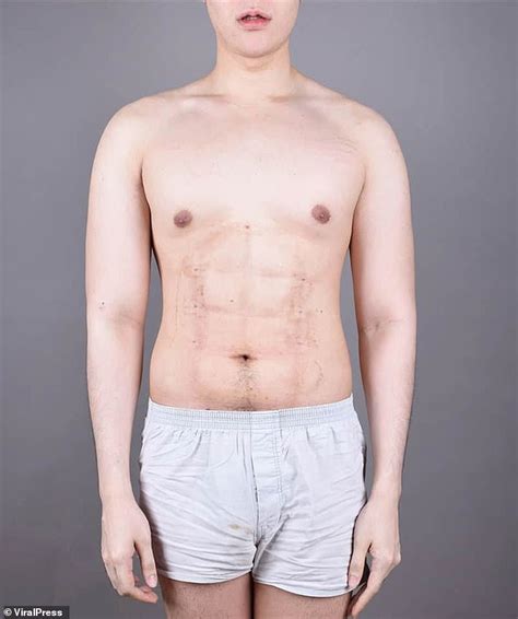 Man From Thailand Undergoes Bizarre Liposuction Procedure To Get Six