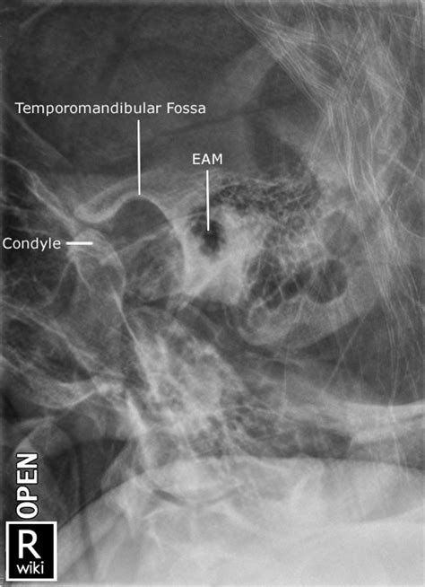 Temporomandibular Joints Tmj Radiographic Anatomy Wikiradiography