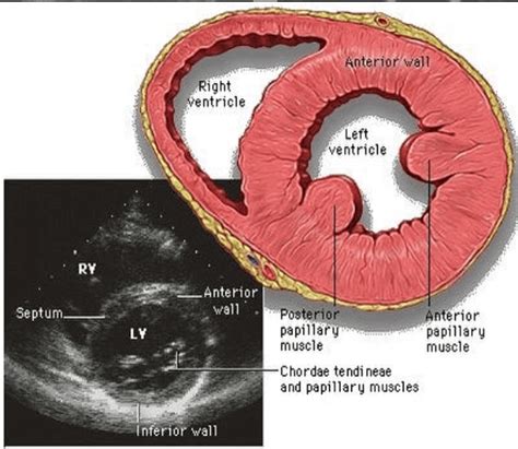 Parasternal Short Axis View Papillary Muscle Level Perfusfind