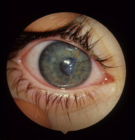 Ocular Laceration Cancer Therapy Advisor
