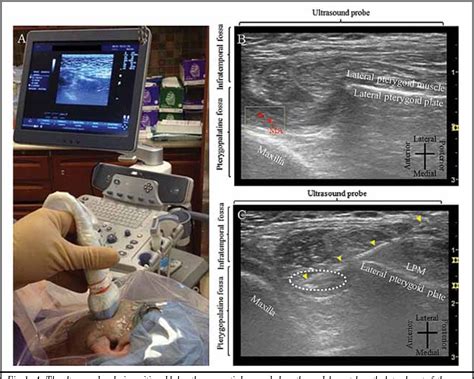 Ultrasound Guided Trigeminal Nerve Block Via The Pterygopalatine Fossa
