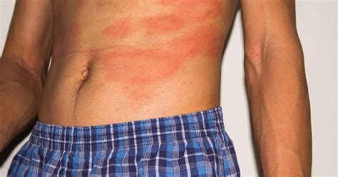 10 Additional Home Remedies For Eczema Facty Health