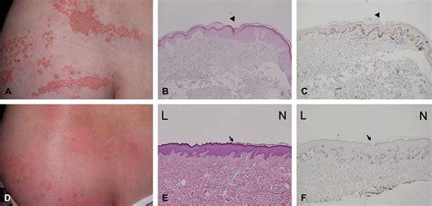 Systematized Linear Porokeratosis A Rare Variant Of Diffuse