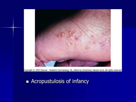 Ppt Andrews Diseases Of The Skin Chapter 10 Pg 239 253 And Chapter 11