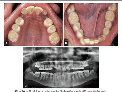 Figure 3 From Dental Manifestations Of Congenital Syphilis In A 12 Year