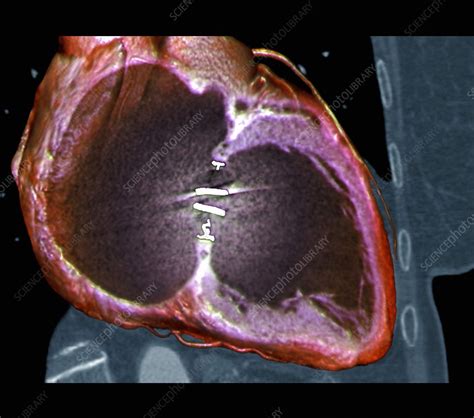Artificial Heart Valve 3d Ct Scan Stock Image C0212299