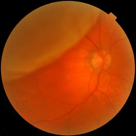 Eye Specialist For Retinal Detachment In Children Retinal Detachment