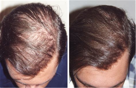 Greffe de cheveux: depuis plus de 15 ans, une équipe est dédiée à la