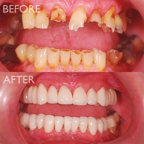 Full Mouth Rehabilitation R K Dental Clinic