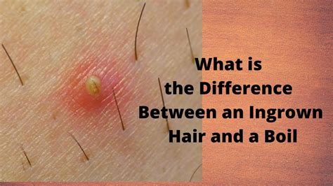 What Is The Difference Between An Ingrown Hair And A Boil Youtube