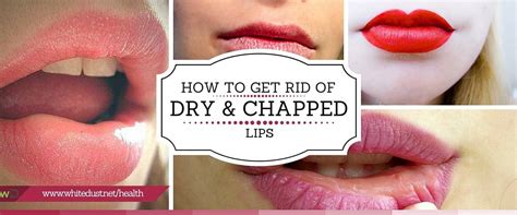 How To Get Rid Of Dry Chapped Lips Chapped Lips Lips Dry Lips