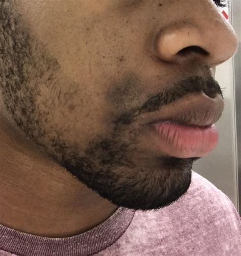 Skin Concerns Ive Had This Dark Mark On My Face For About 4 Years Now