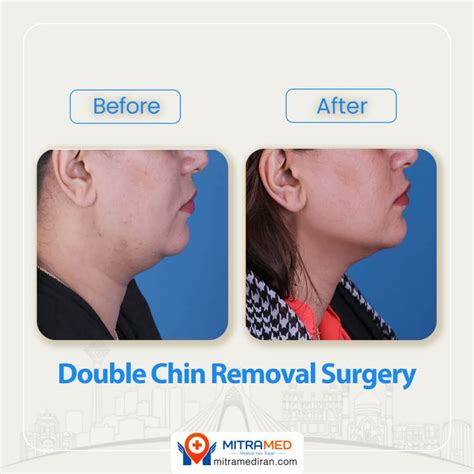Double Chin Removal Surgery Before And After Photos Mitramed